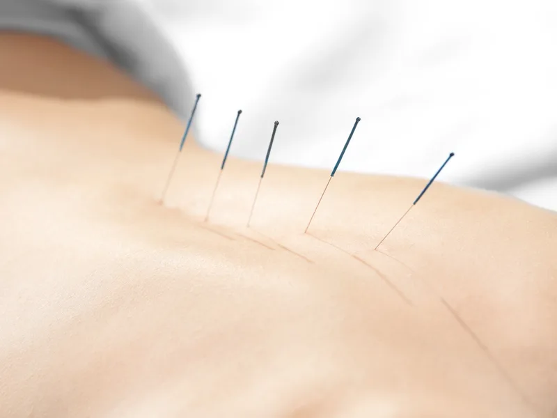 Acupuncture at Tahoe Chiropractic Clinic in South Lake Tahoe