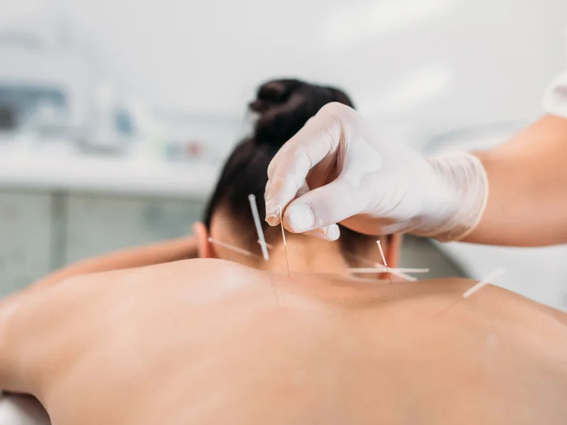 Dry Needling at Tahoe Chiropractic Clinic in South Lake Tahoe